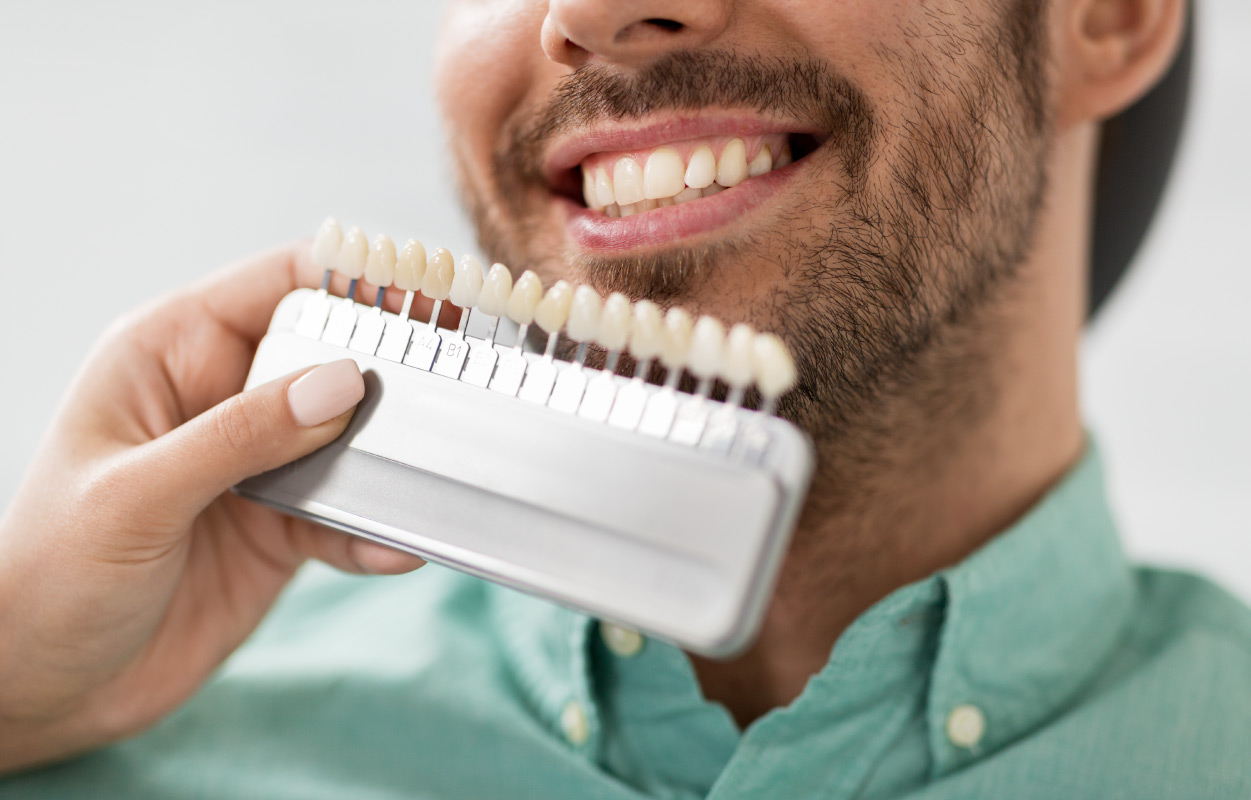 veneer shades examples at dentist